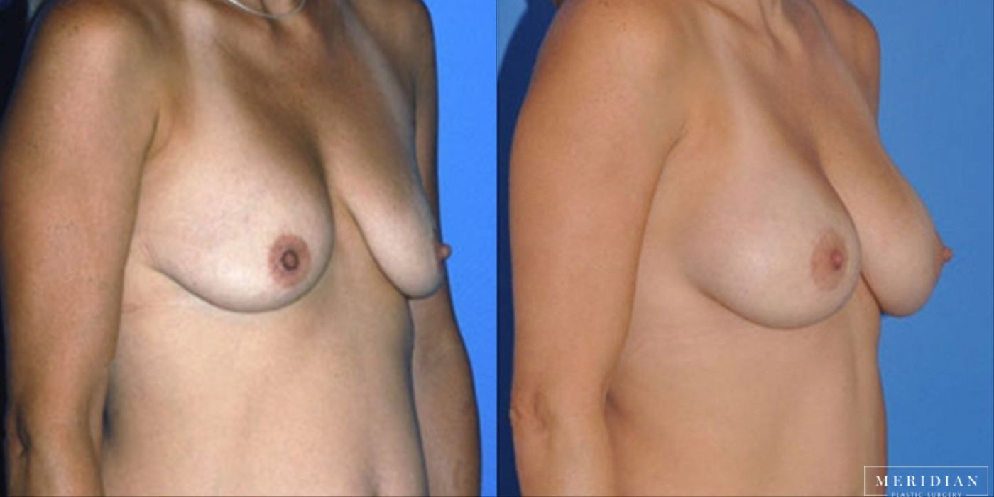 Breast Lift - Thumbnail 2