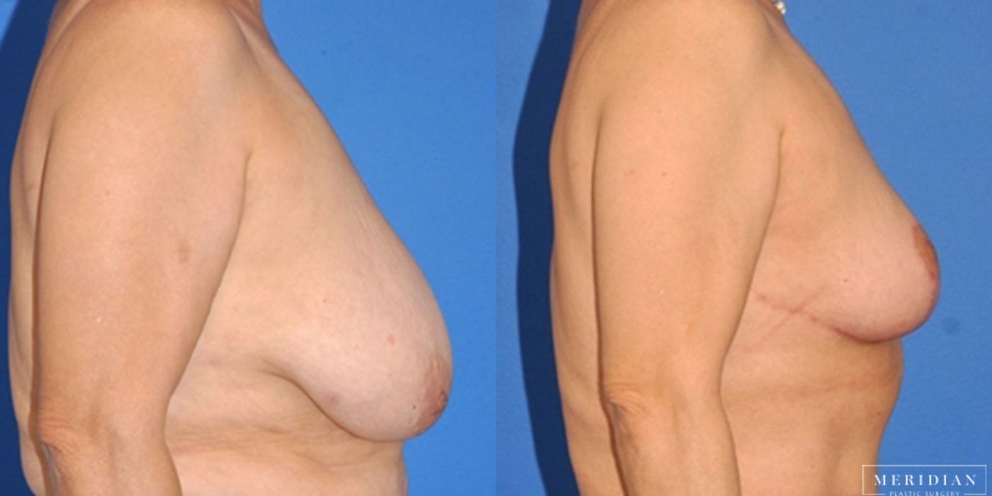 Breast Lift - Thumbnail 2