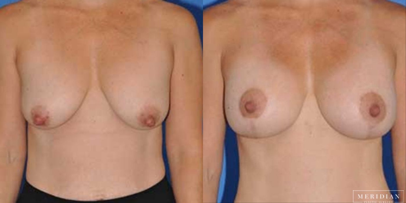 Breast Lift - Case 8545