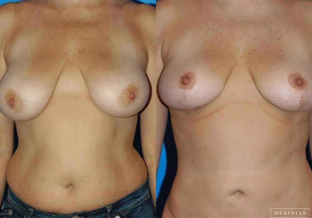 Breast Lift - Case 7864