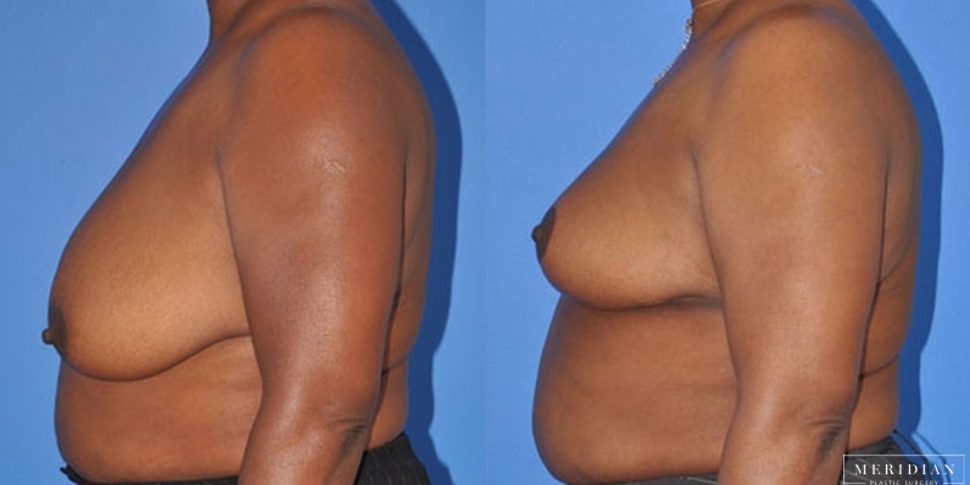 Breast Lift - Thumbnail 2