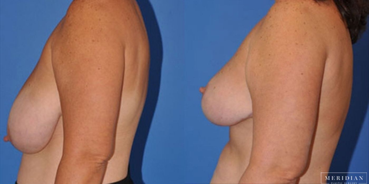 Breast Lift - Case 8550