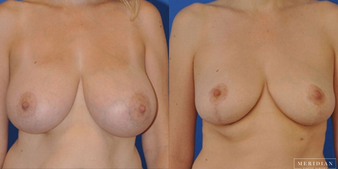 Breast Reduction - Case 8559