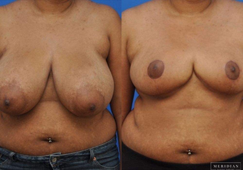 Breast Reduction - Case 7880