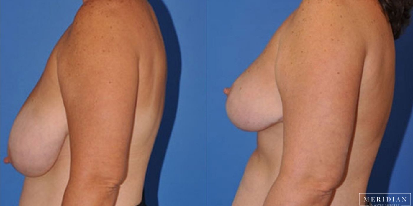 Breast Reduction - Case 8566