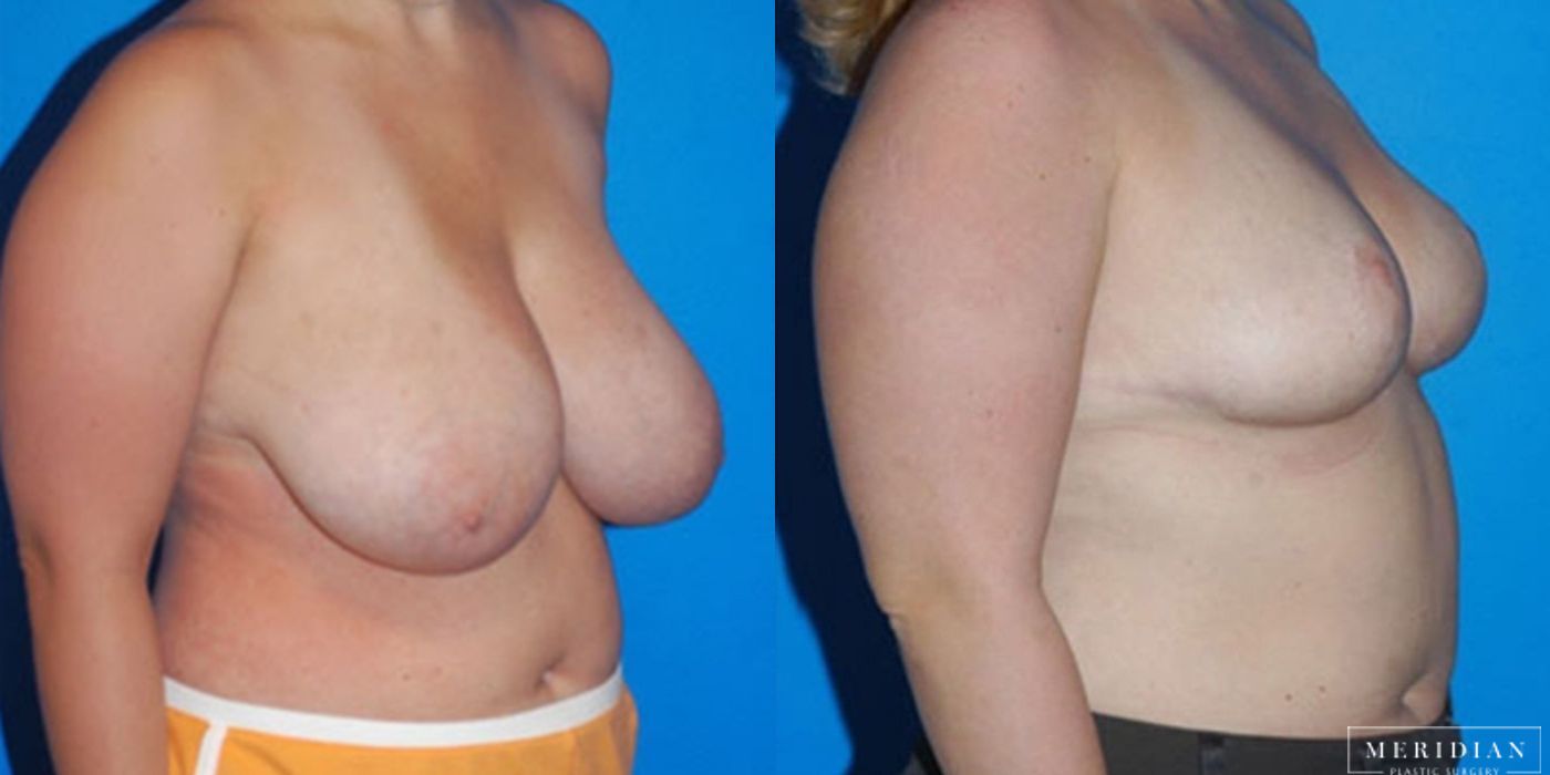 Breast Reduction - Thumbnail 2