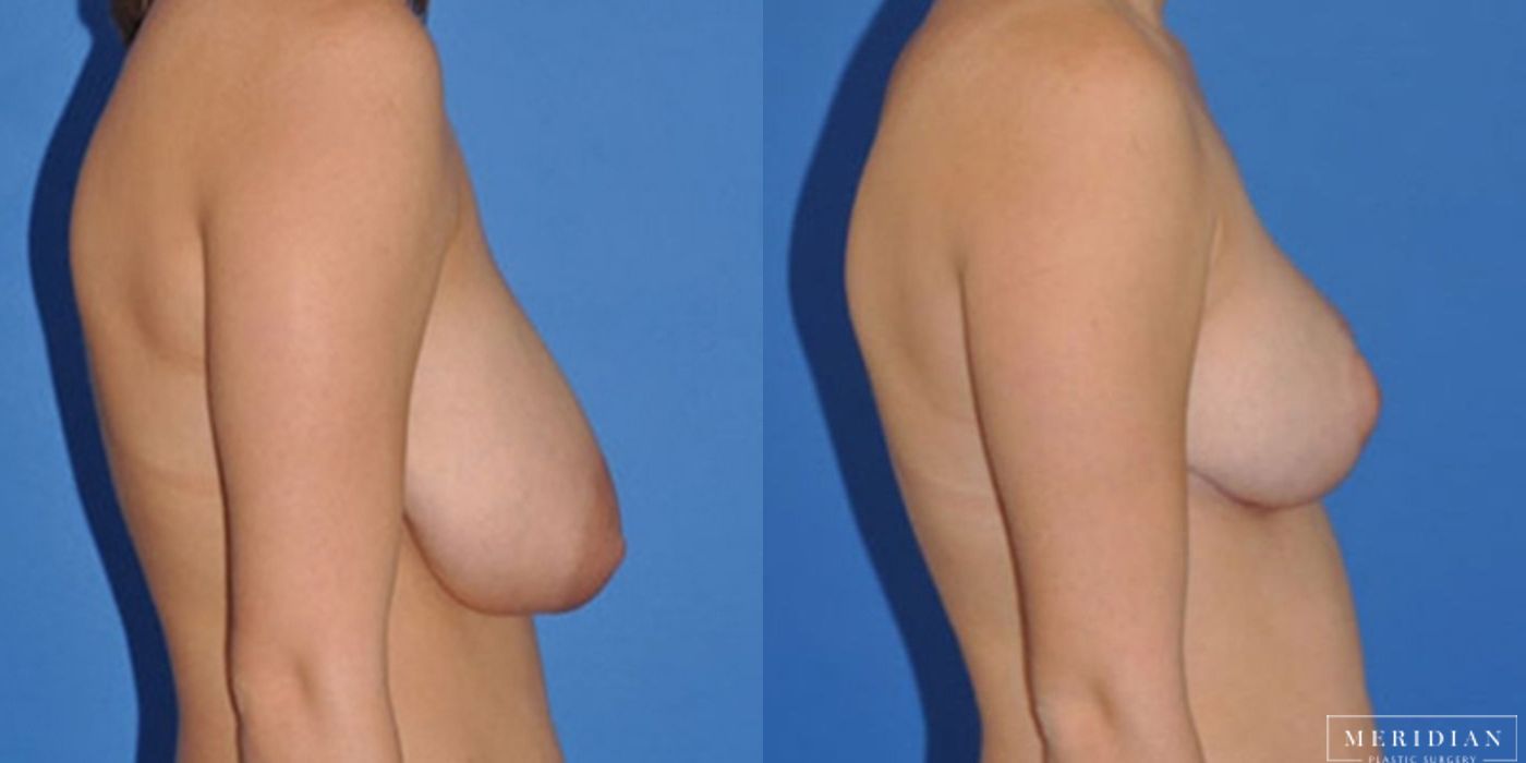 Breast Reduction - Thumbnail 2