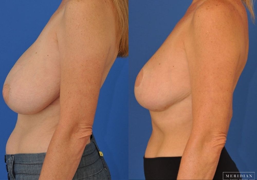 Breast Reduction - Thumbnail 2