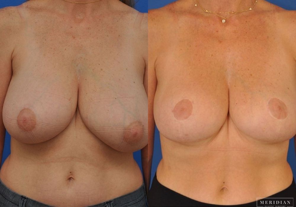 Breast Reduction - Case 7886