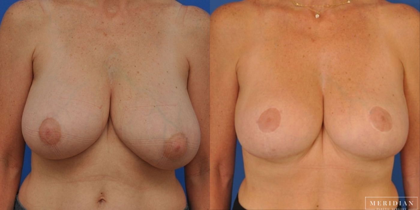 Breast Reduction - Case 8565