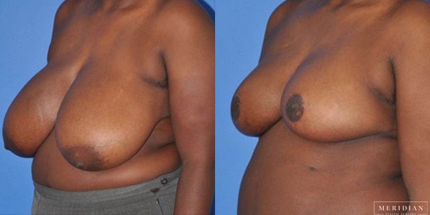 Breast Reduction - Thumbnail 2