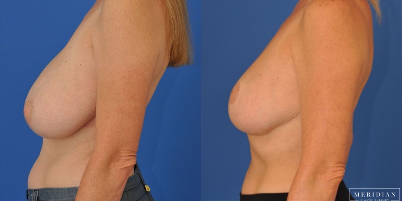 Breast Reduction - Thumbnail 2