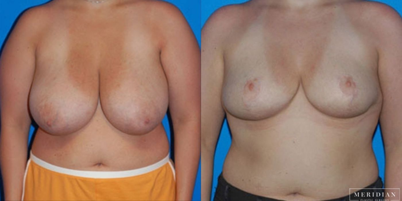 Breast Reduction - Case 8557