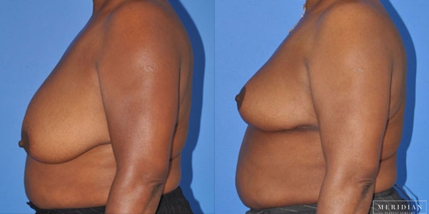 Breast Reduction - Case 8562