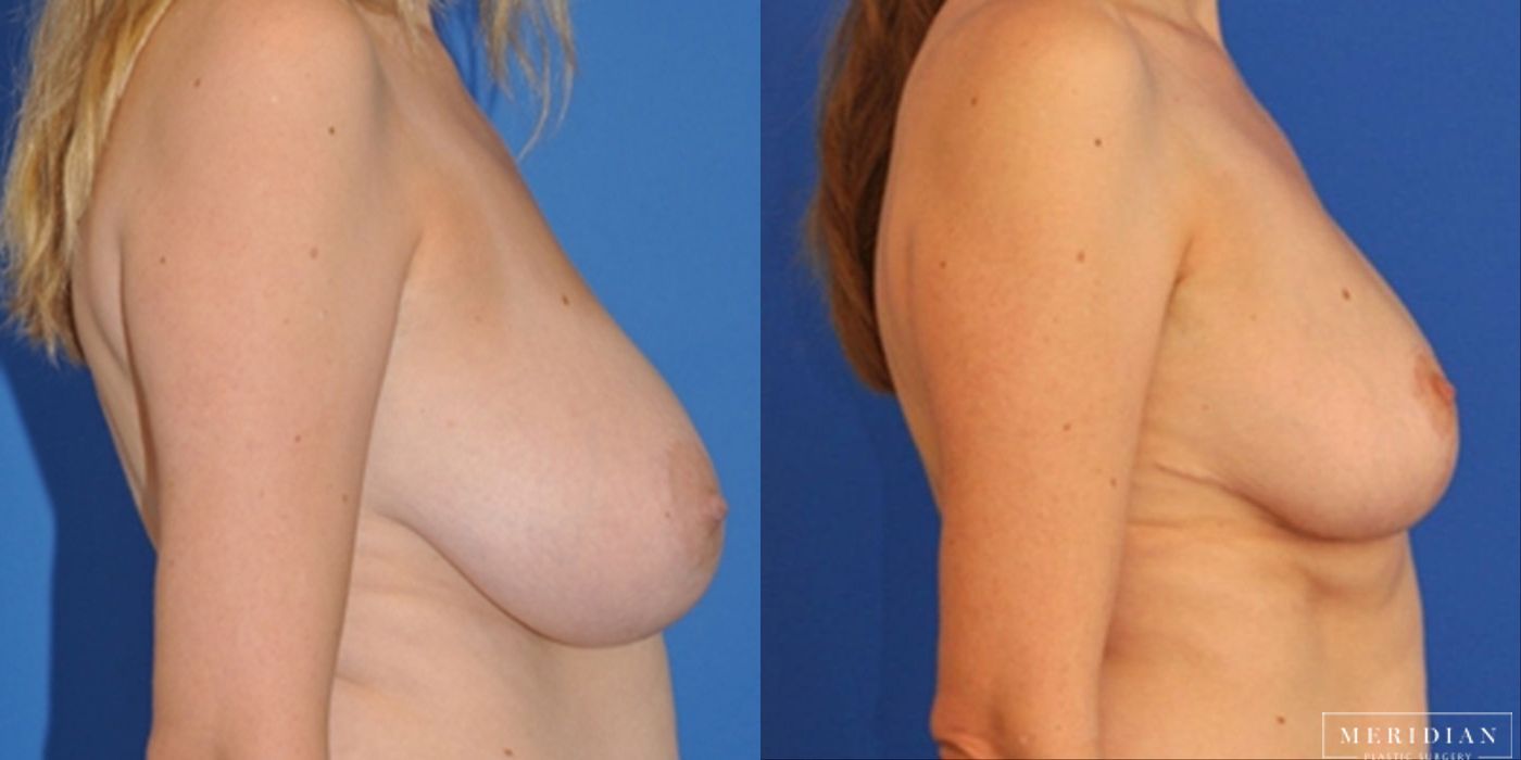 Breast Reduction - Thumbnail 2
