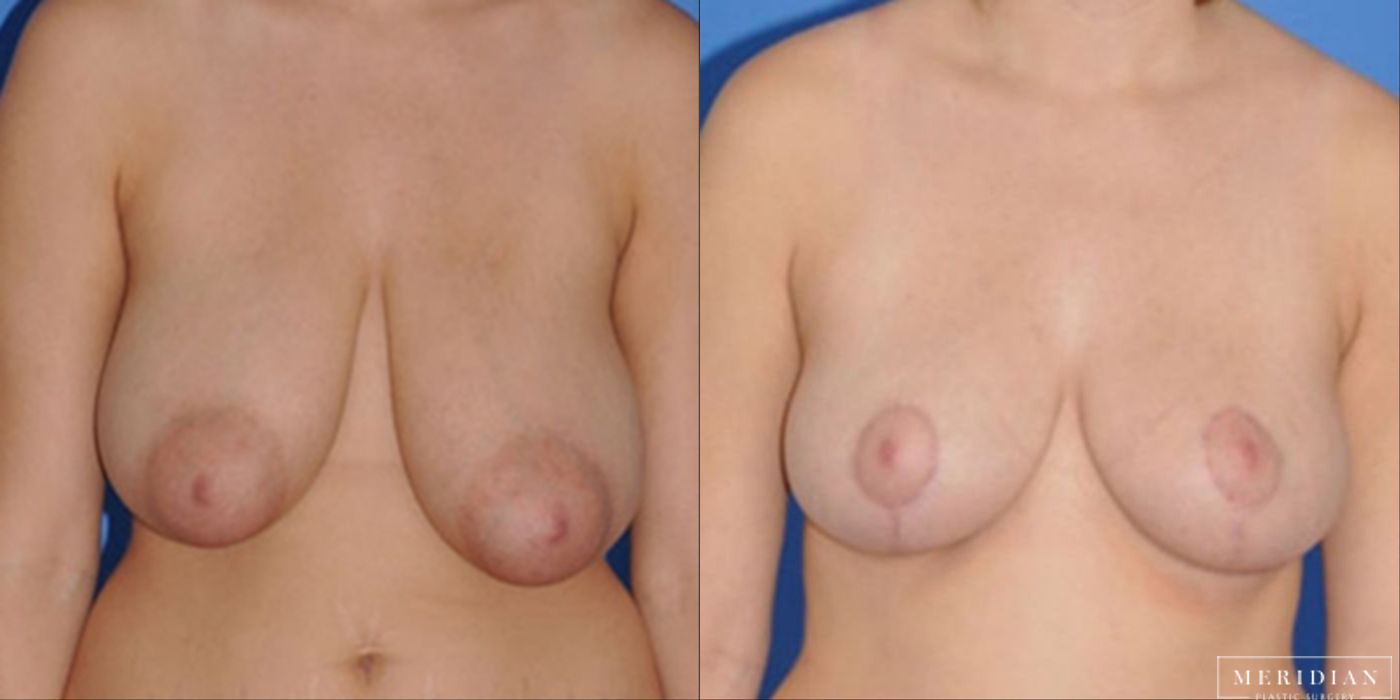Breast Reduction - Case 8561