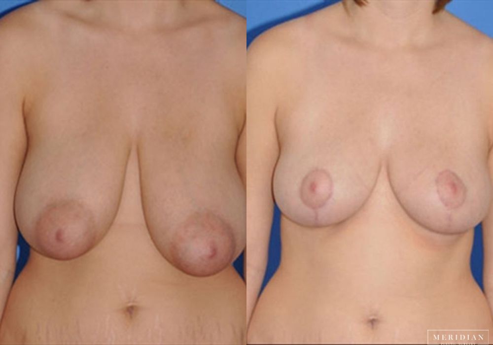 Breast Reduction - Case 7882