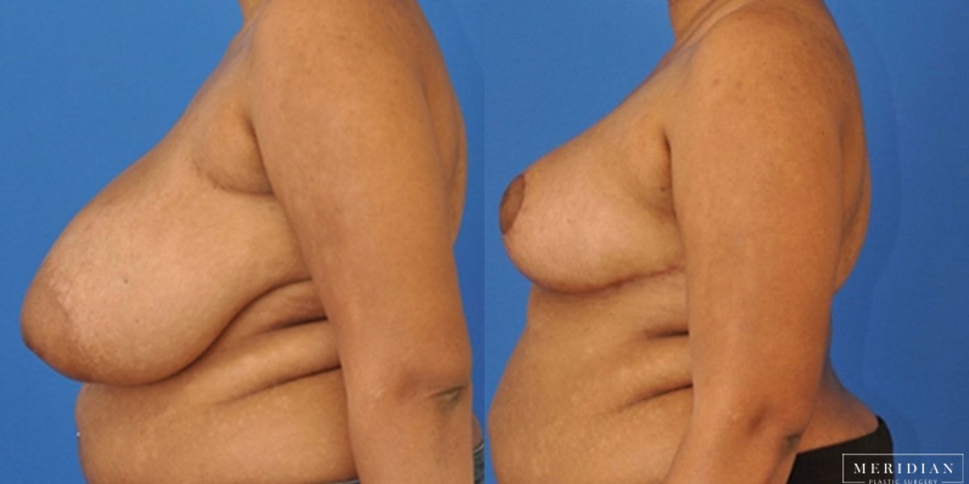 Breast Reduction - Case 8560
