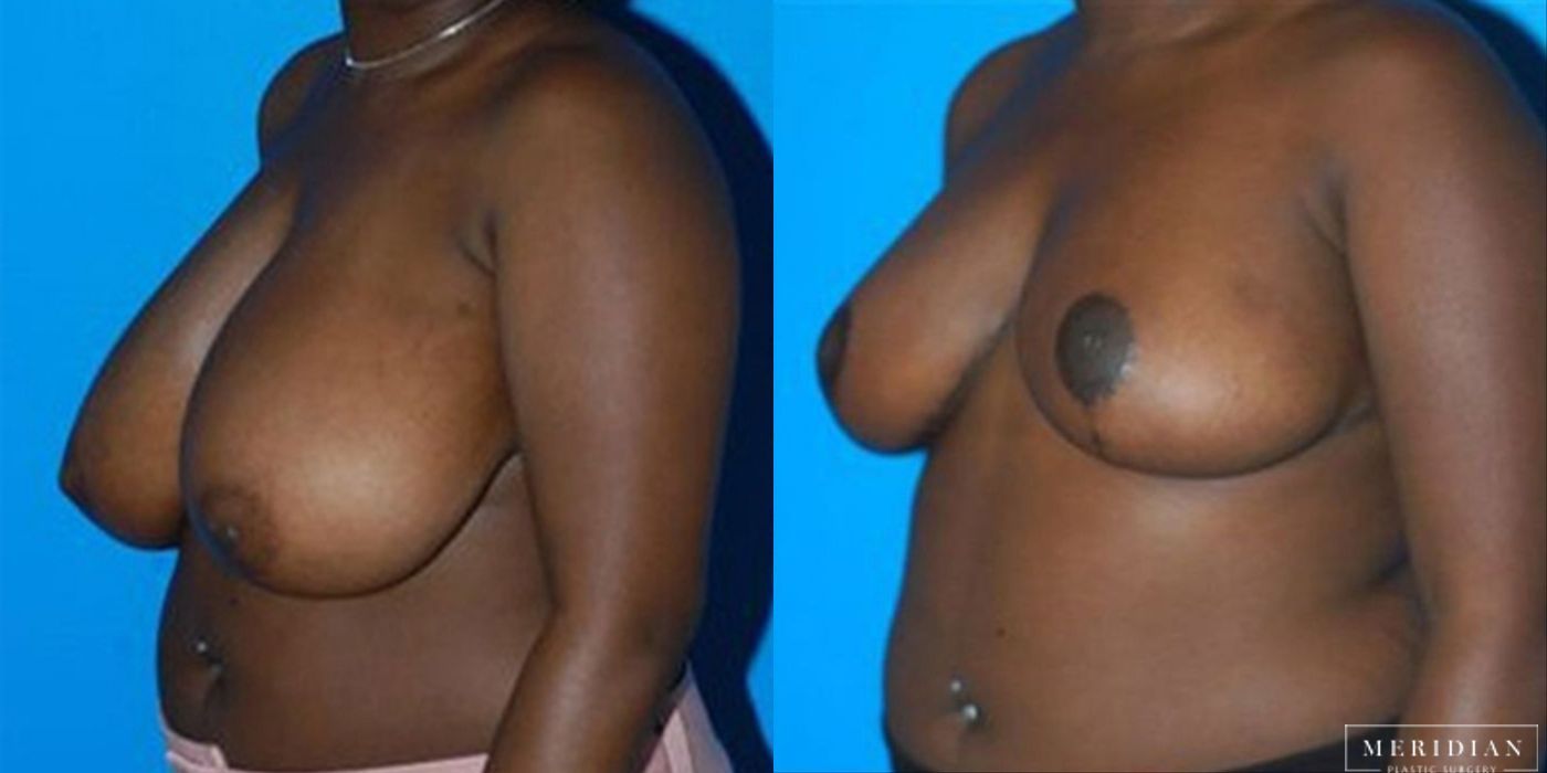 Breast Reduction - Case 8558