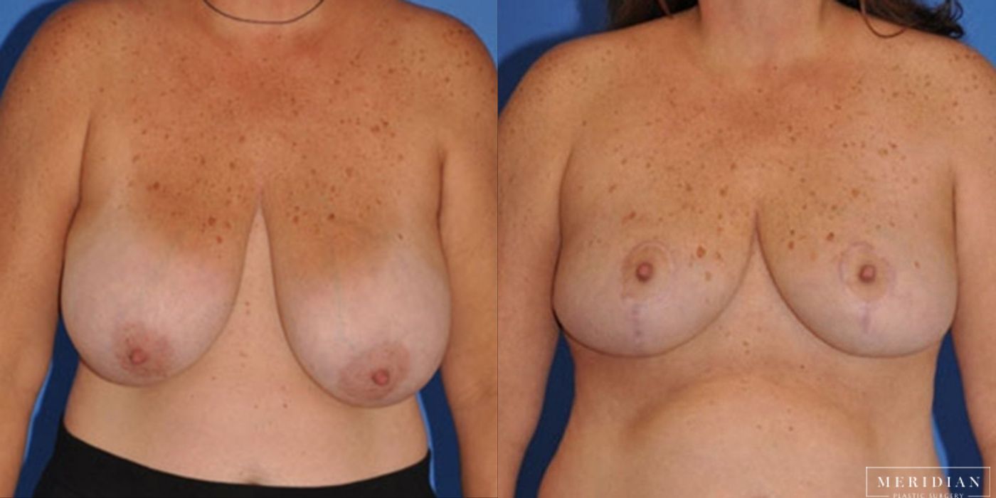 Breast Reduction - Thumbnail 2