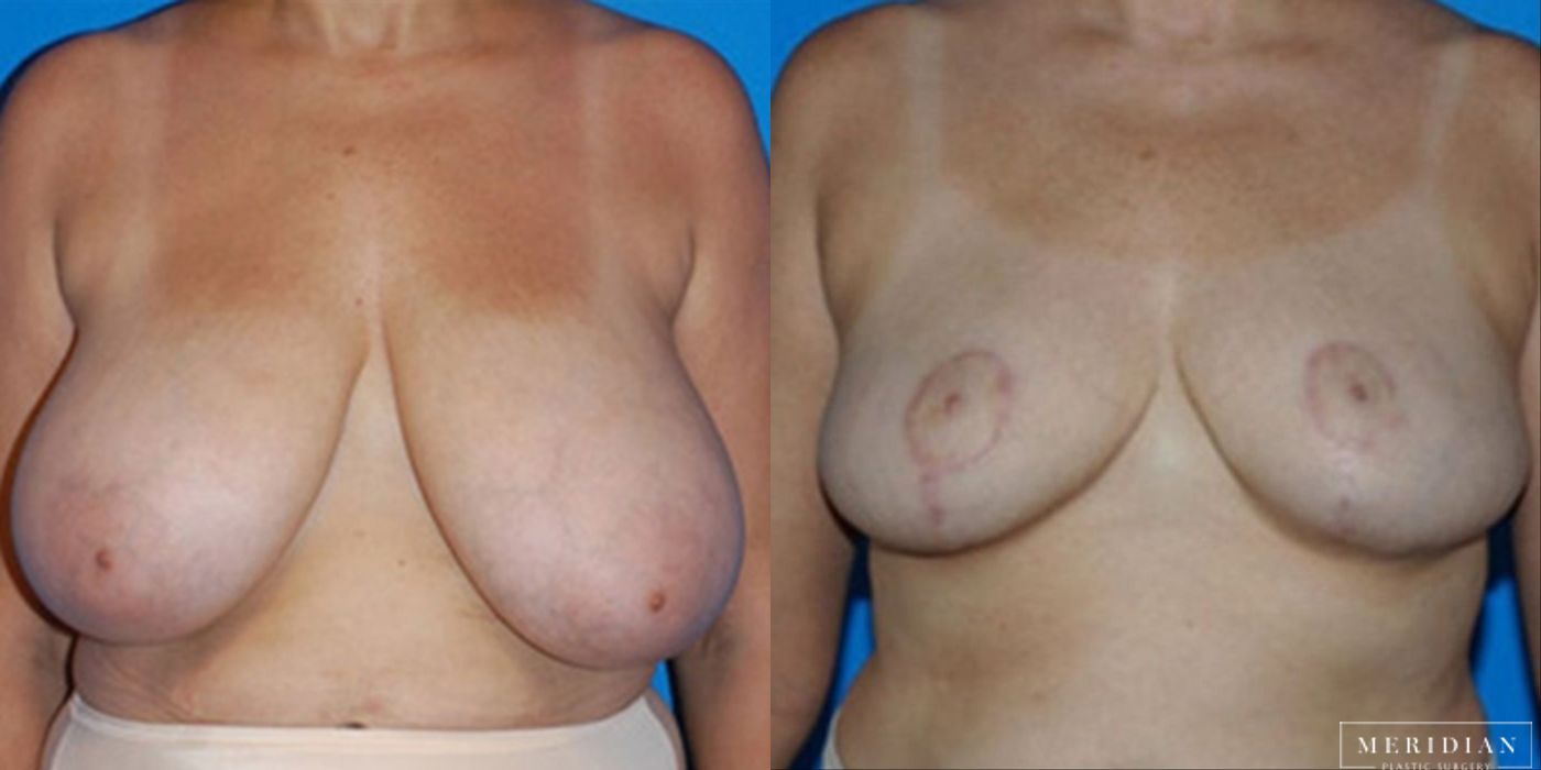 Breast Reduction - Thumbnail 2