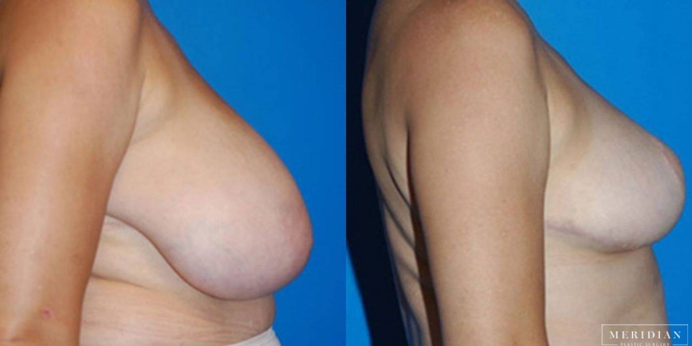 Breast Reduction - Case 8564