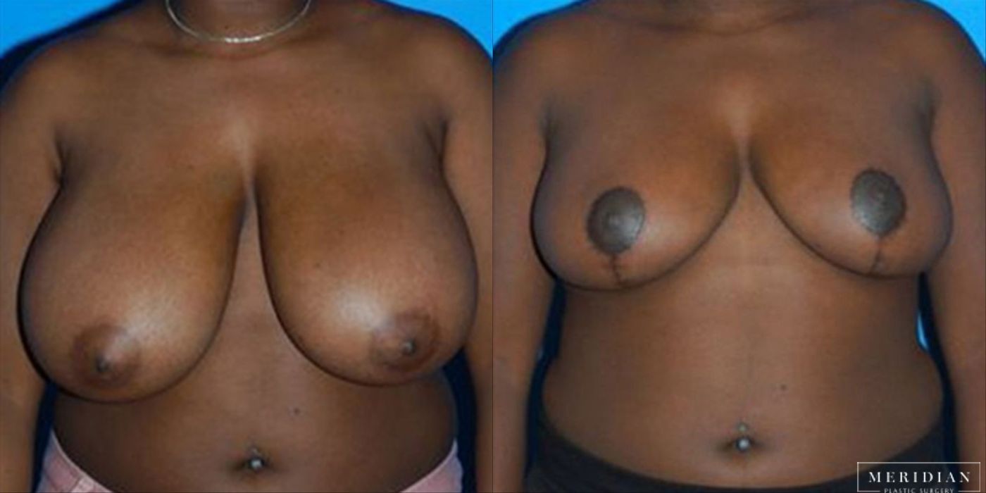 Breast Reduction - Thumbnail 2