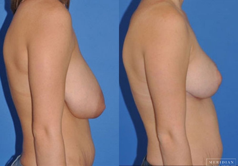 Breast Reduction - Thumbnail 2