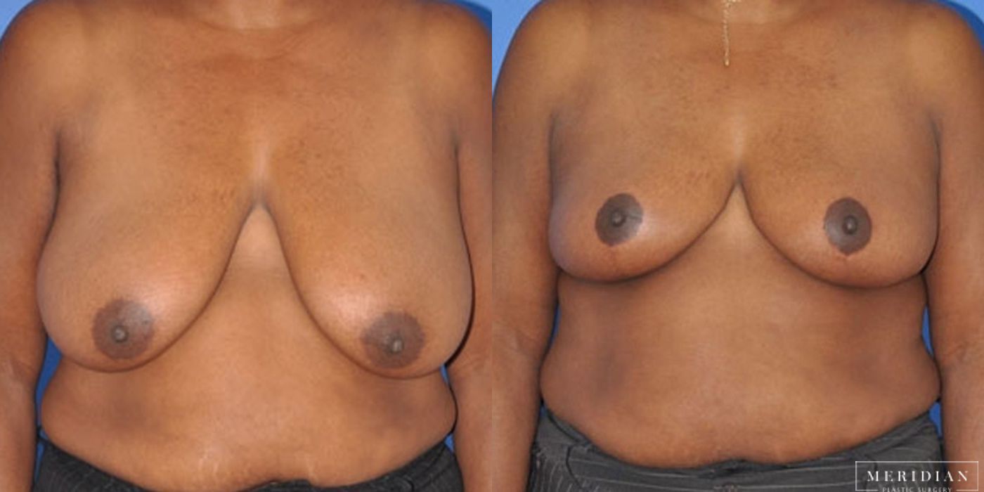 Breast Reduction - Thumbnail 2