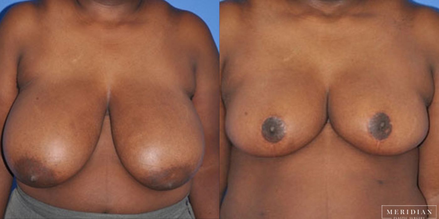 Breast Reduction - Case 8563