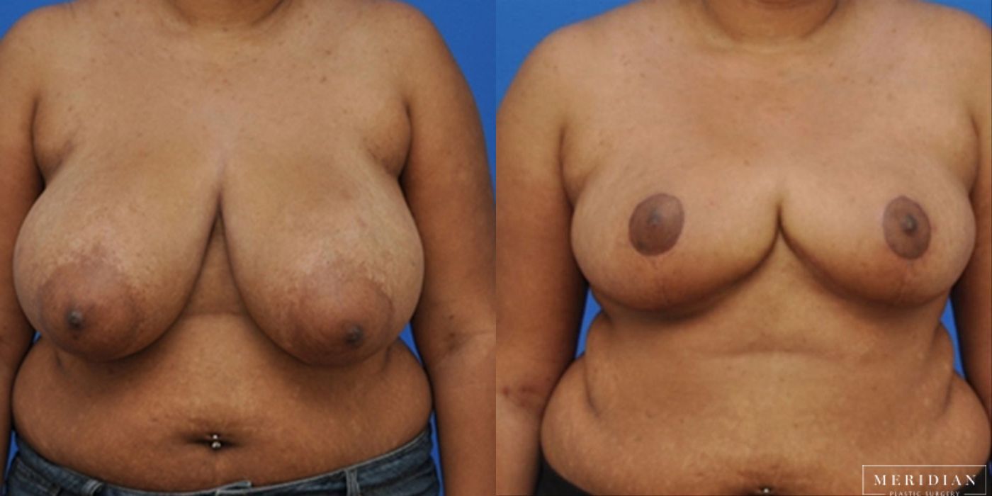 Breast Reduction - Thumbnail 2