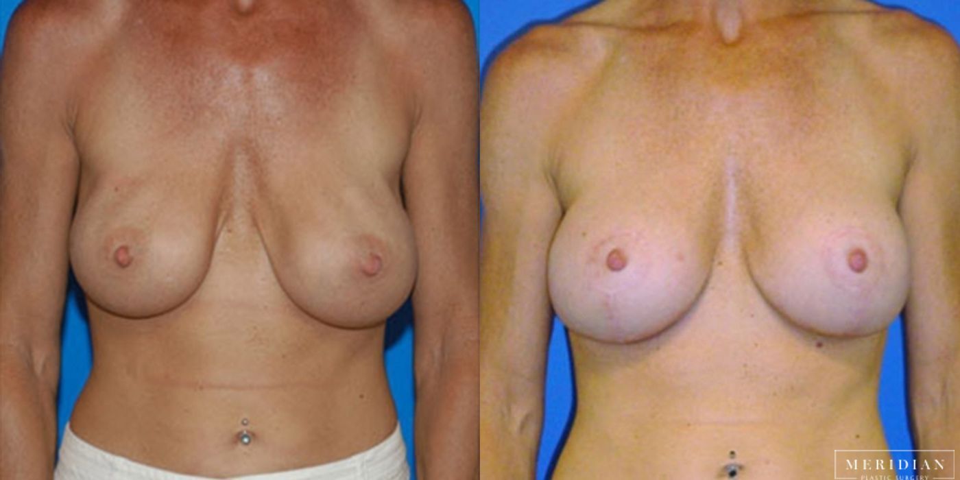 Breast Revision - Case 8572