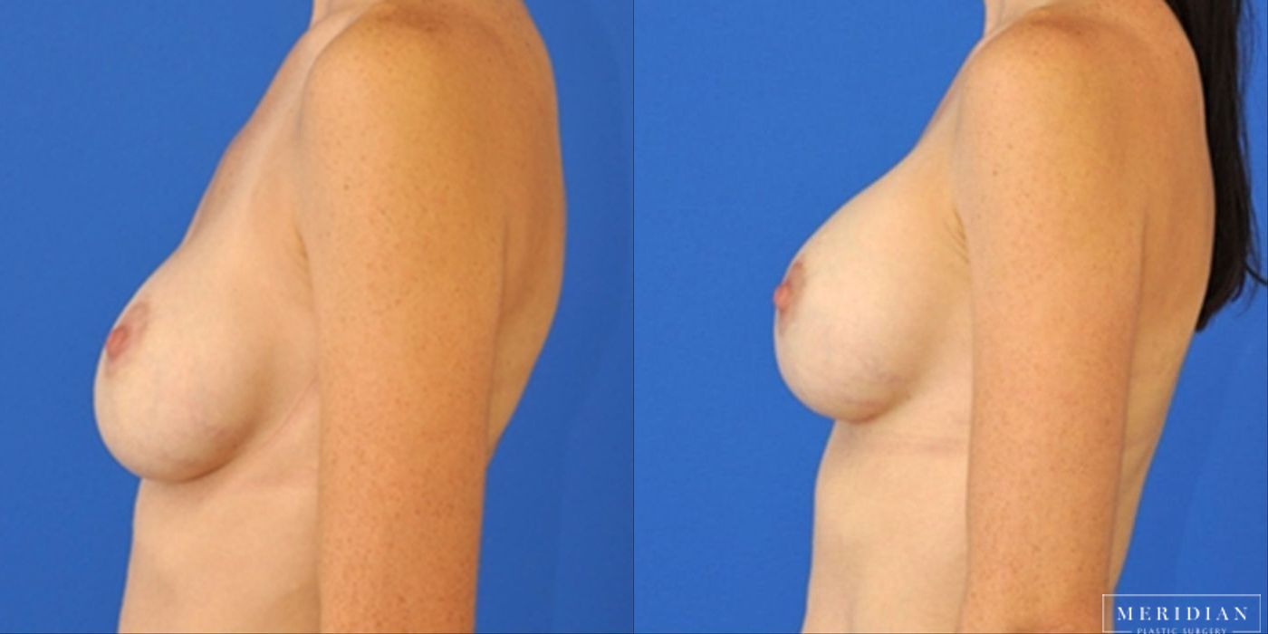 Breast Revision - Thumbnail 2