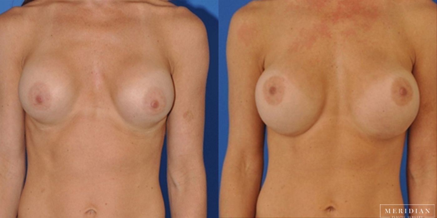 Breast Revision - Case 8578