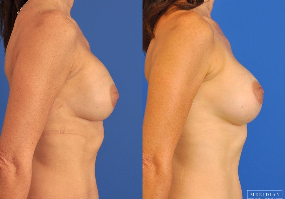 Breast Revision - Thumbnail 4