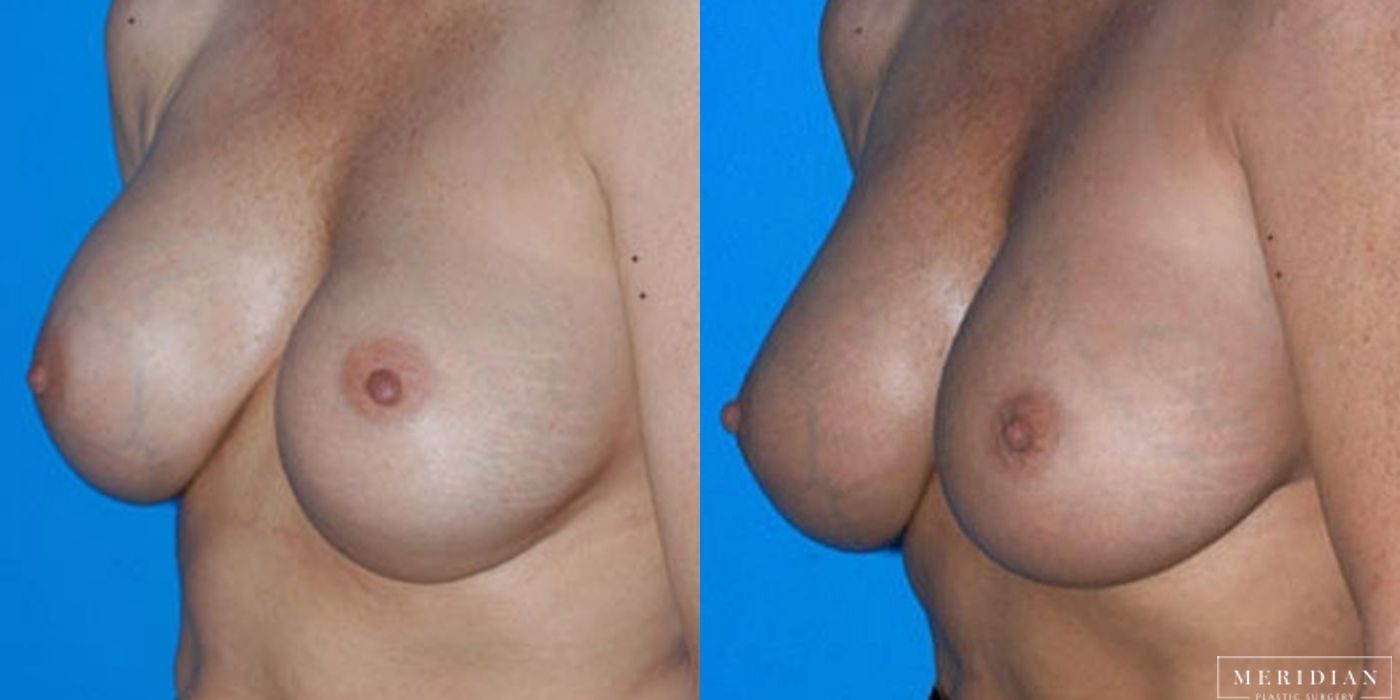 Breast Revision - Thumbnail 2