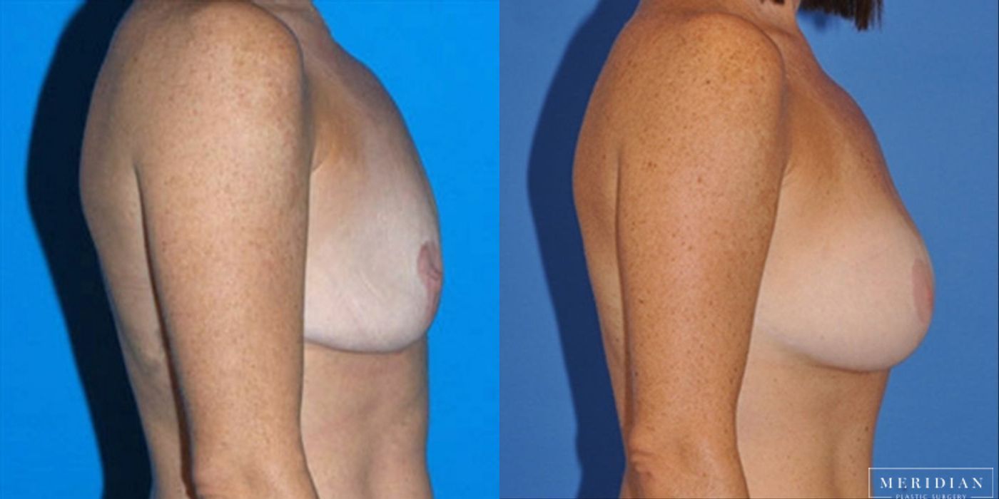 Breast Revision - Thumbnail 2