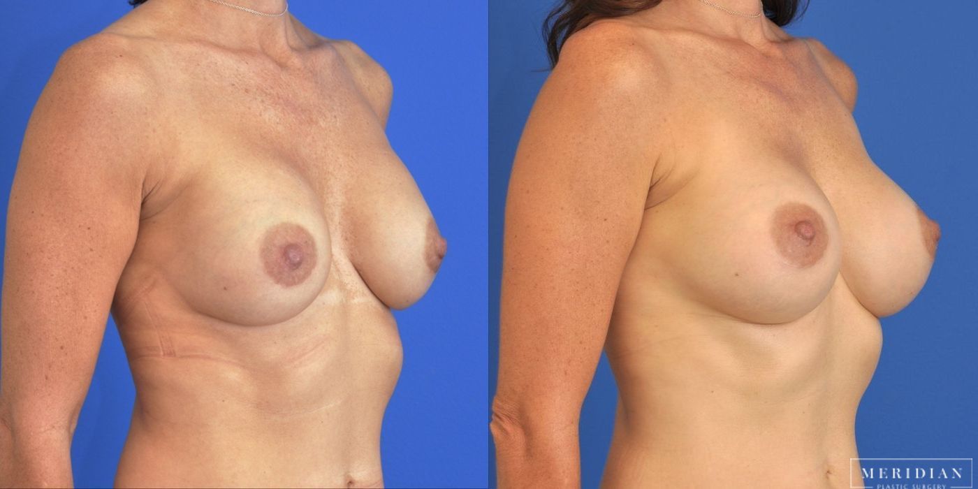 Breast Revision - Thumbnail 3