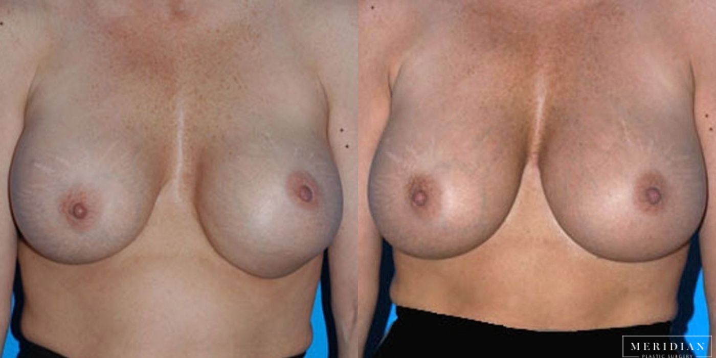 Breast Revision - Case 8569
