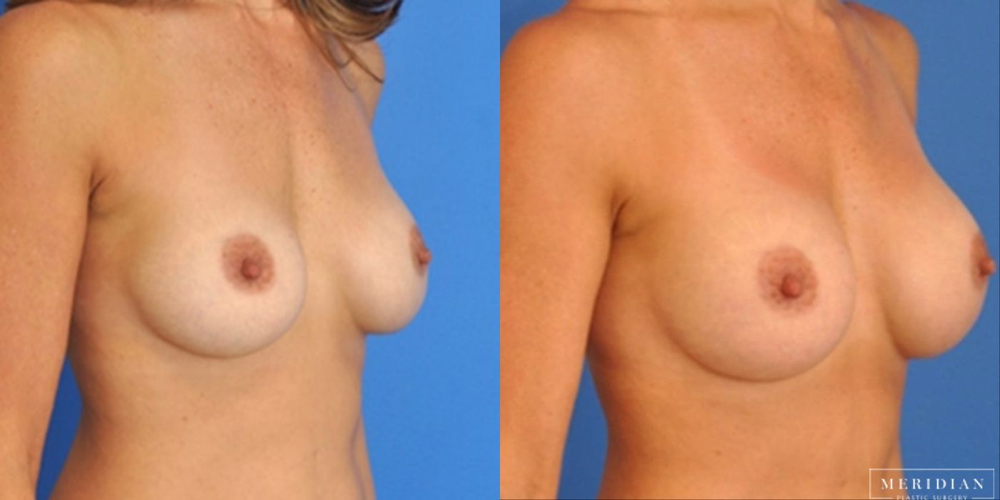 Breast Revision - Thumbnail 2