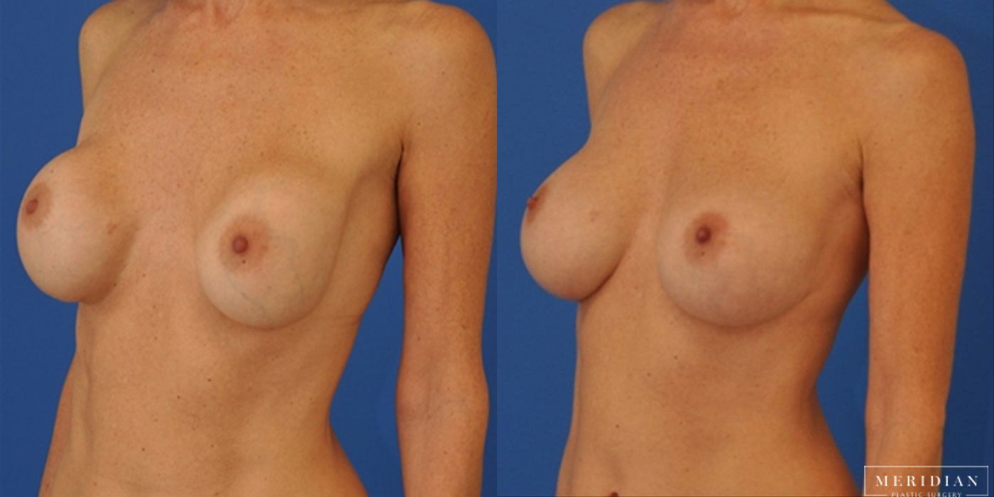Breast Revision - Thumbnail 2