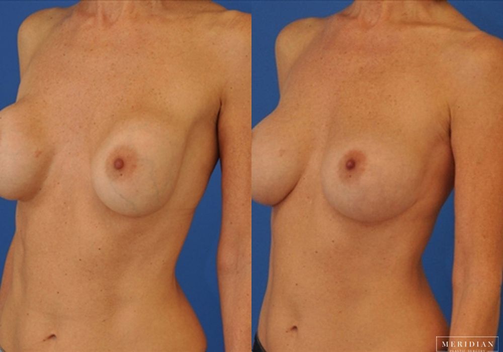 Breast Revision - Thumbnail 2