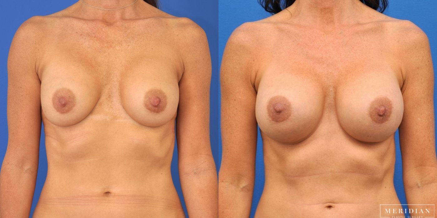 Before and after procedure result