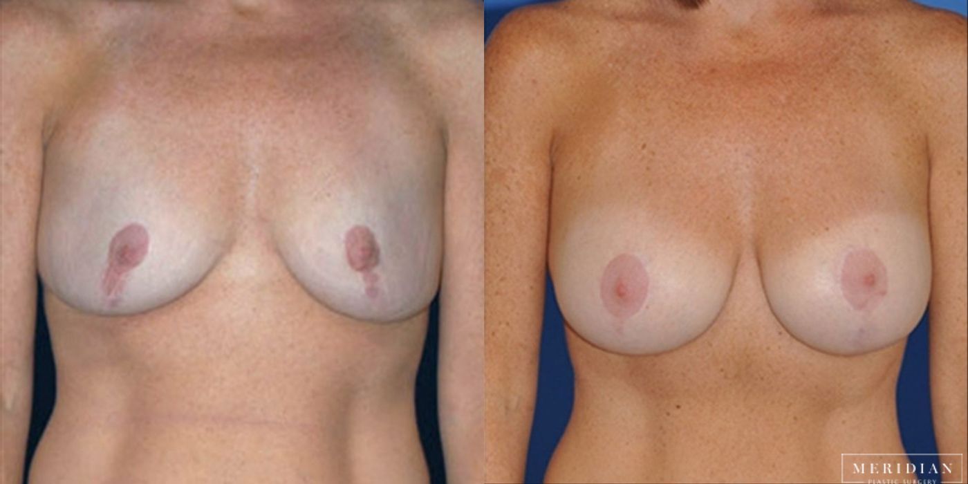 Breast Revision - Case 8571