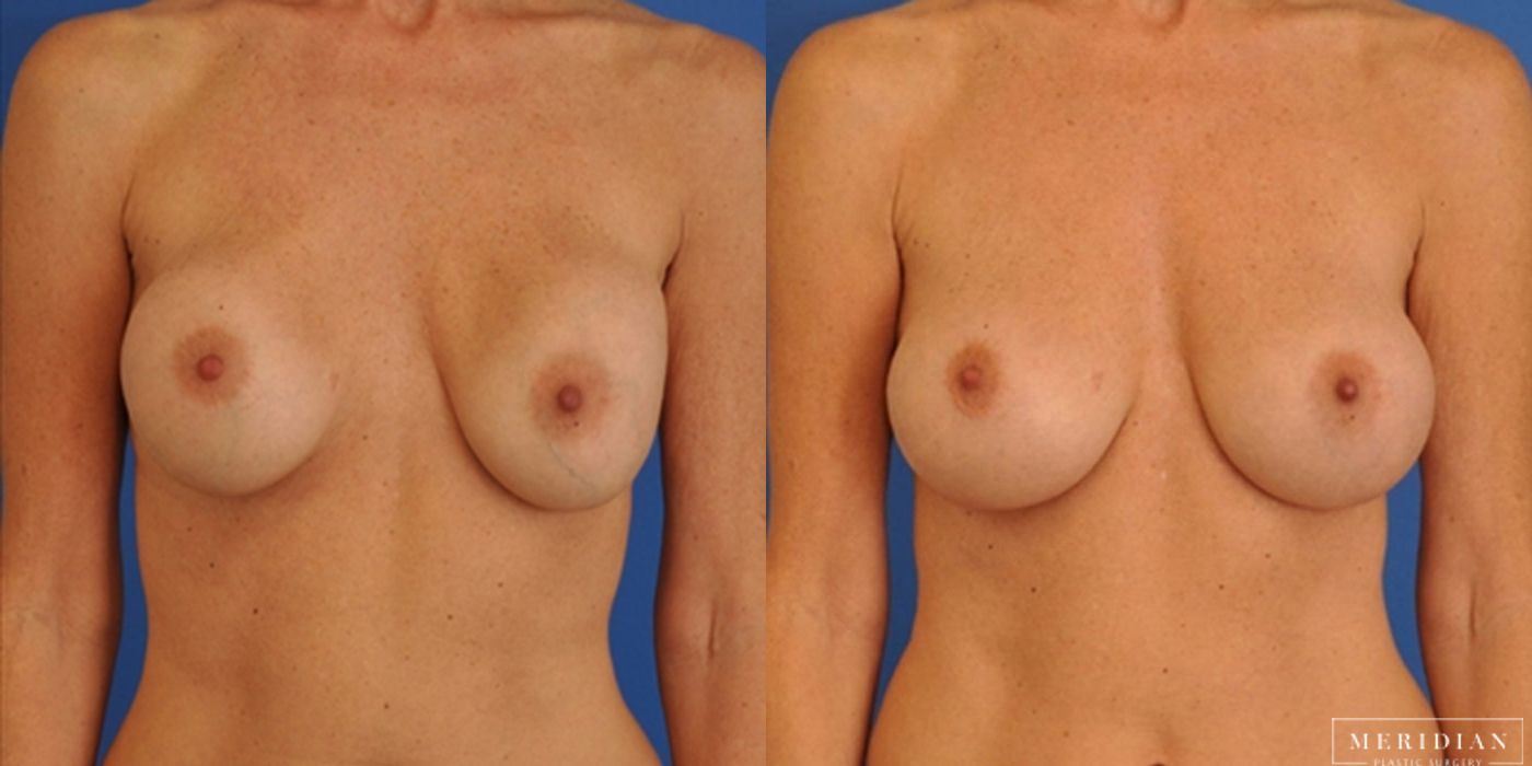Breast Revision - Case 8570