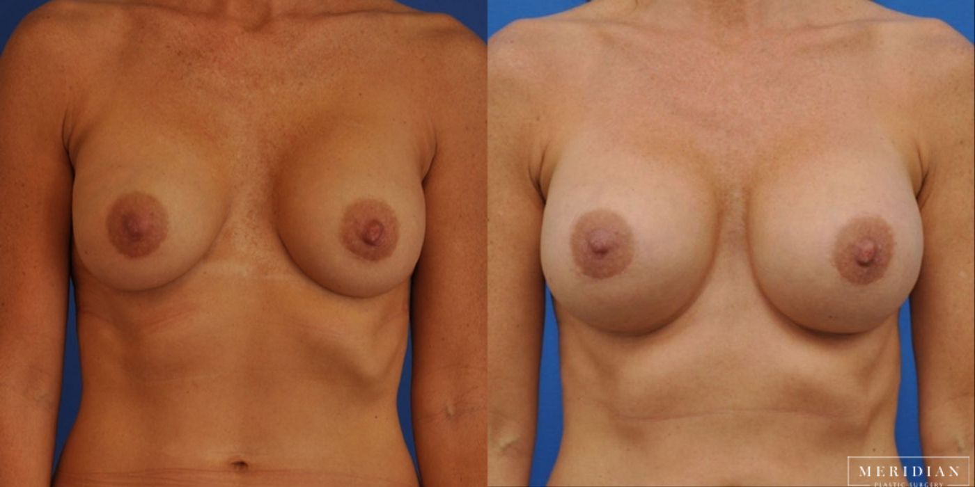 Breast Revision - Case 8577