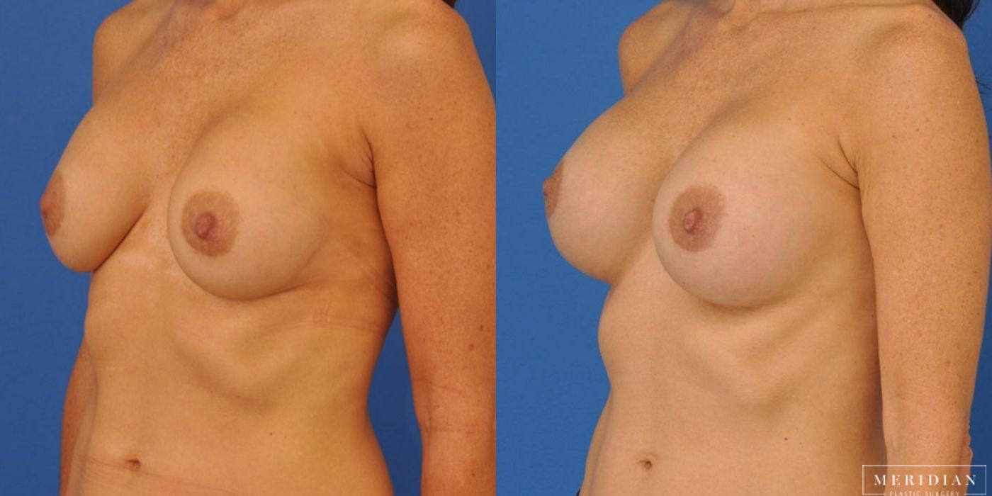 Breast Revision - Thumbnail 2