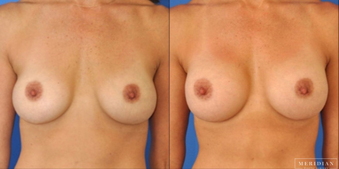 Breast Revision - Case 8574