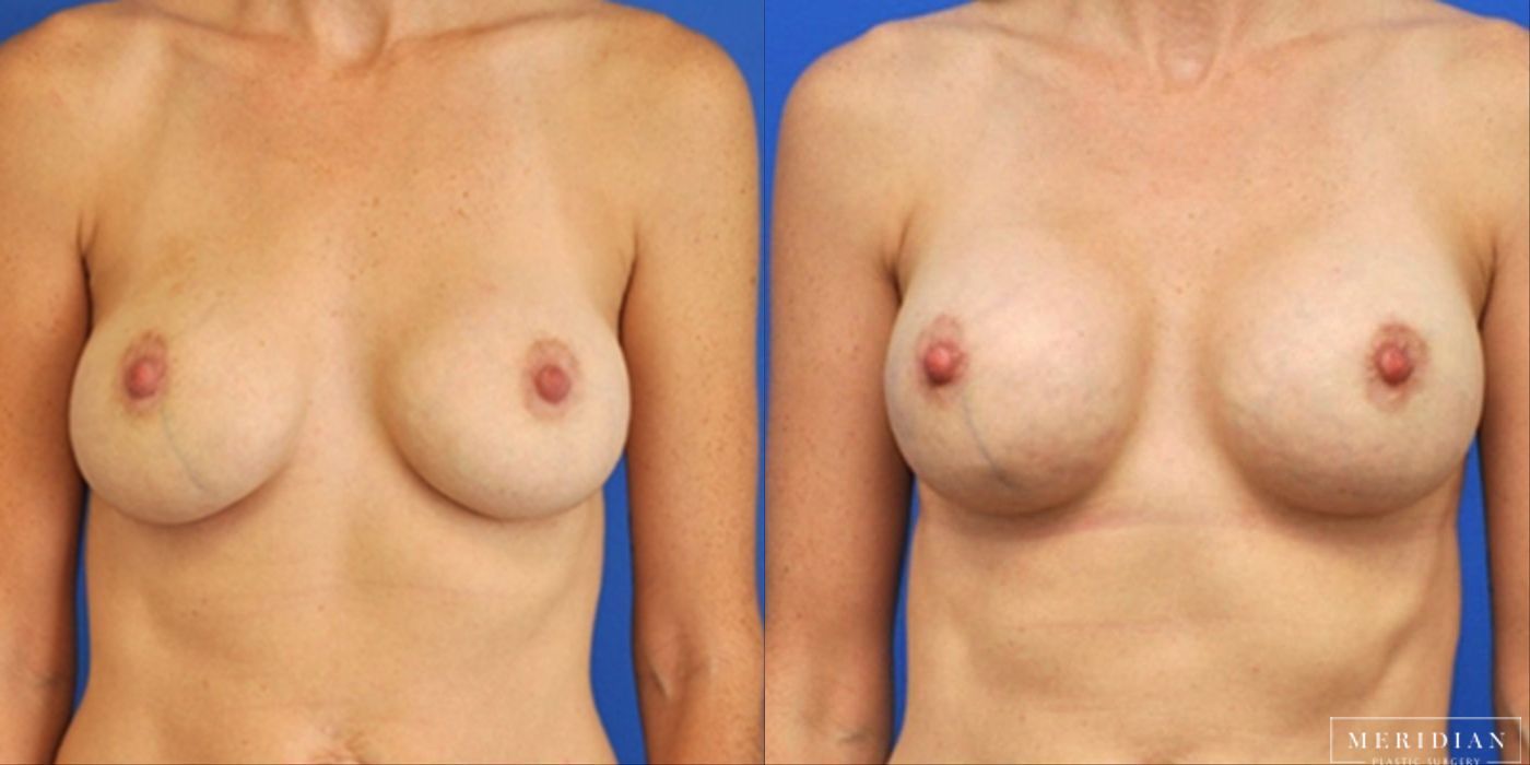 Breast Revision - Case 8575