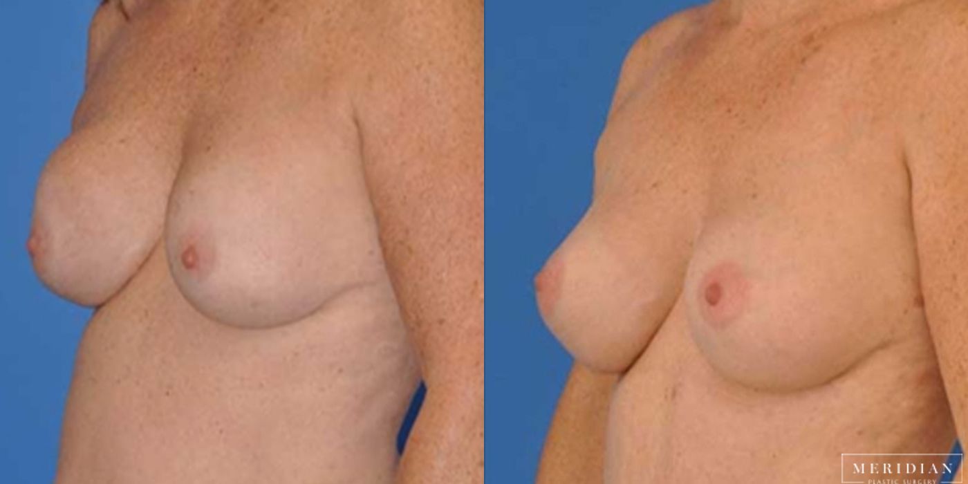 Breast Revision - Thumbnail 2